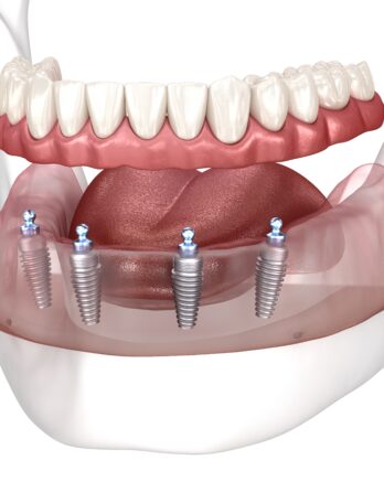All You Need to Know About All on 4 Dental Implants…..