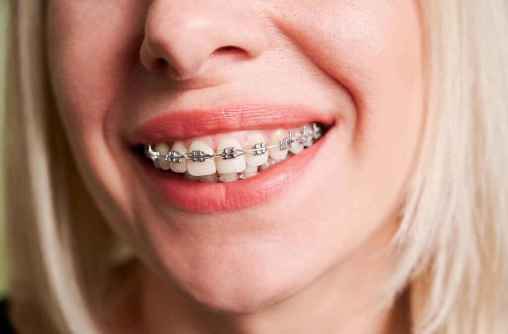 blonde woman with metal braces on teeth 2022 05 30 22 49 58 utc