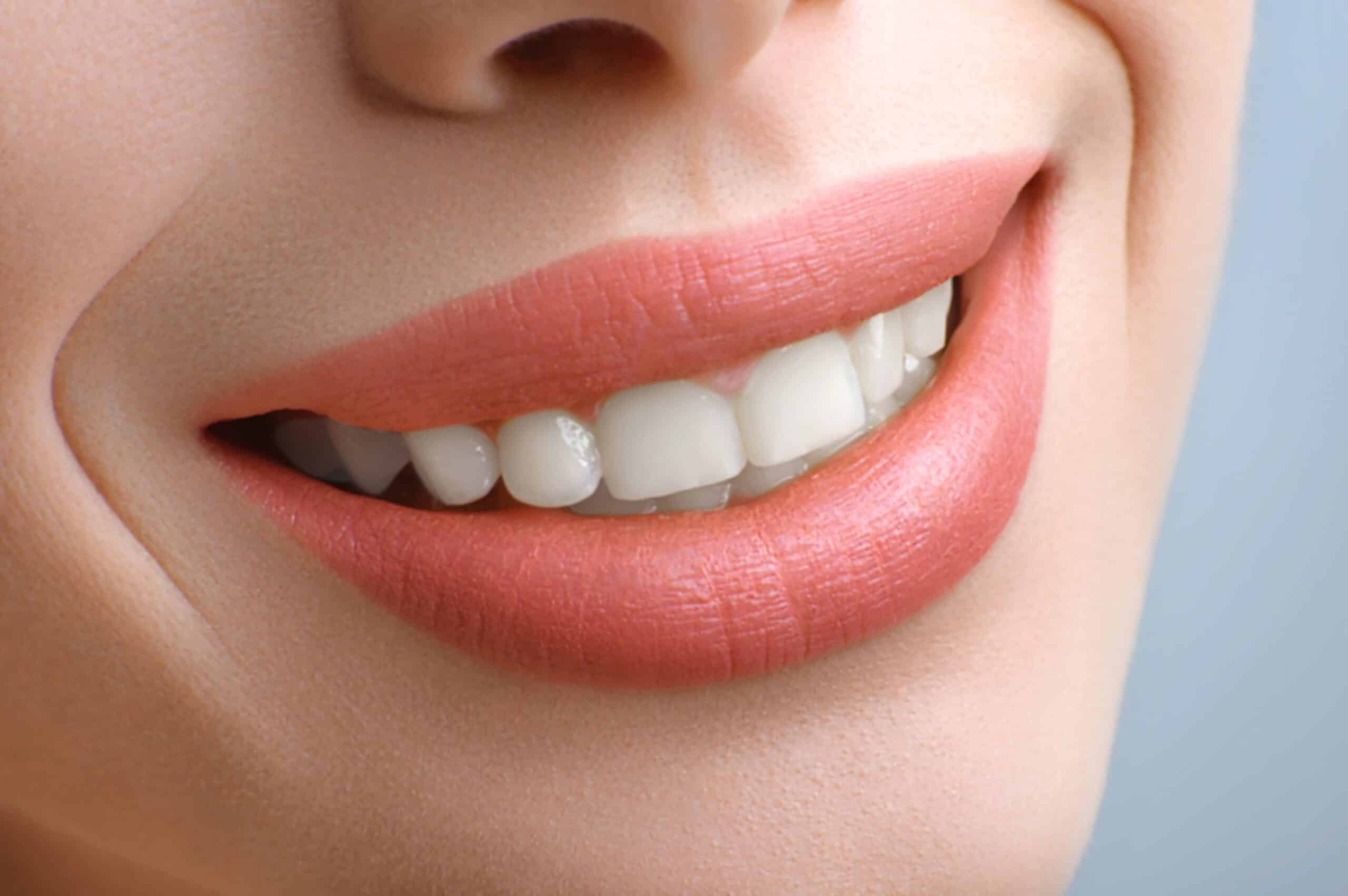 Smile a Pretty Smile – Veneers to the Rescue