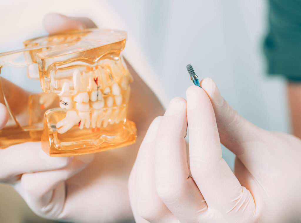 dentist holding dental implat 2021 08 26 16 53 50 utc scaled e1698666954150