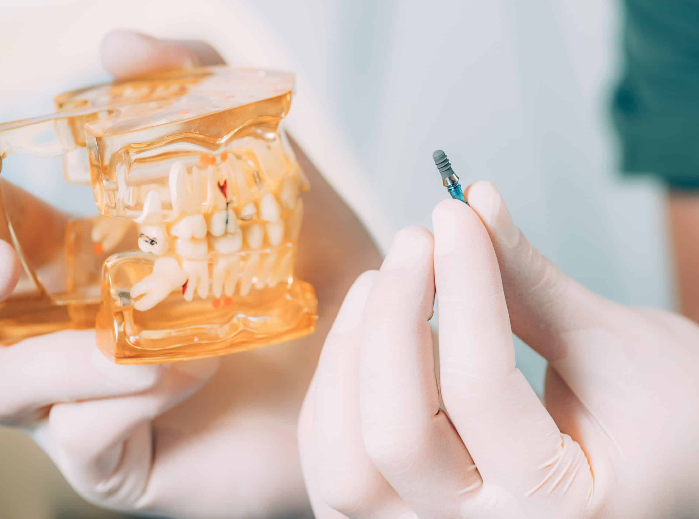 dentist holding dental implat 2021 08 26 16 53 50 utc scaled e1698666954150