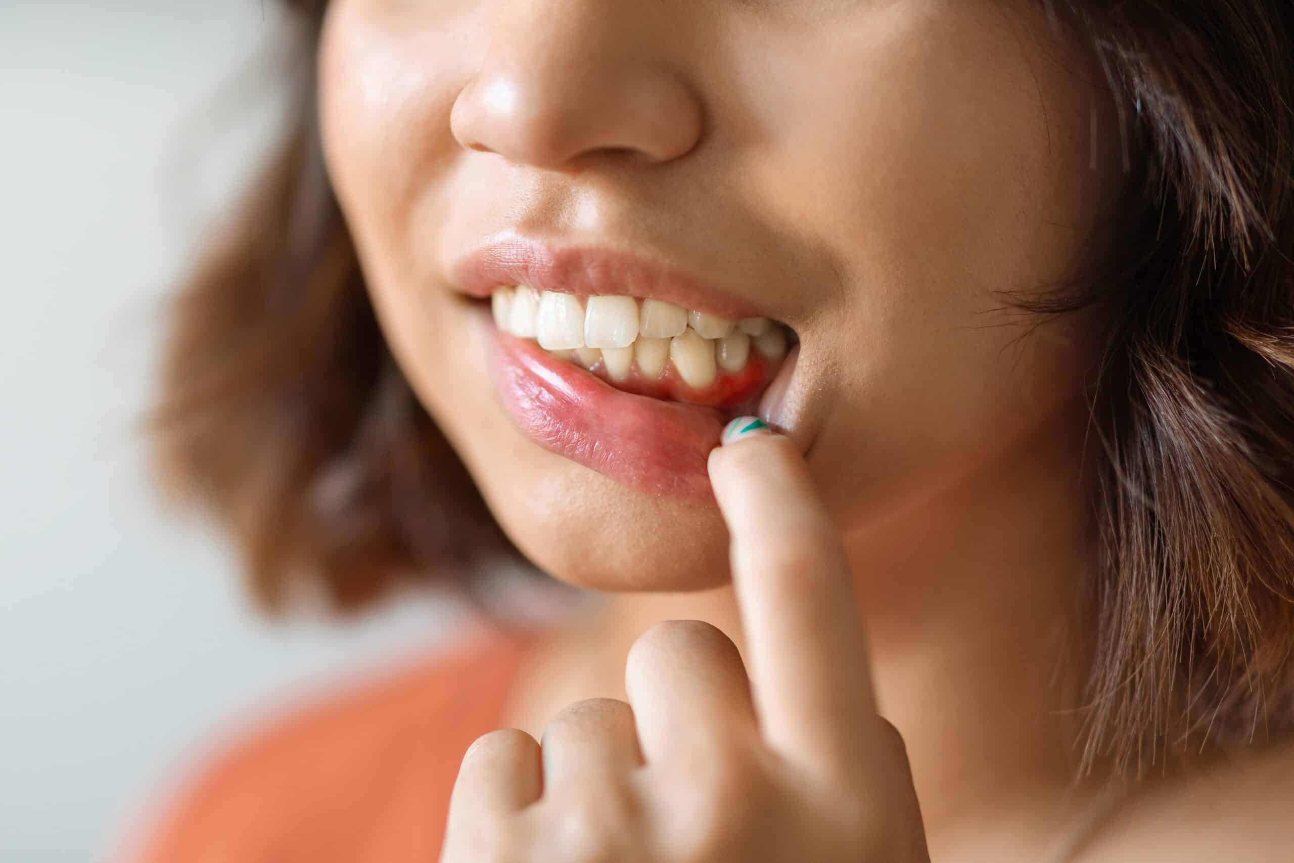 Gum Recession: Signs, Causes & Treatments