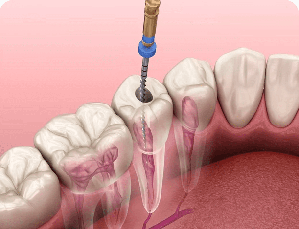 services Root Canal Treatment31 1