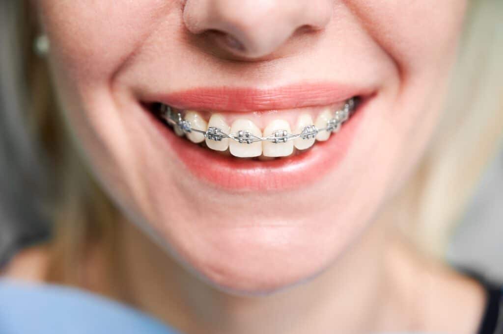 smiling young woman with braces on teeth 2022 05 30 22 50 19 utc