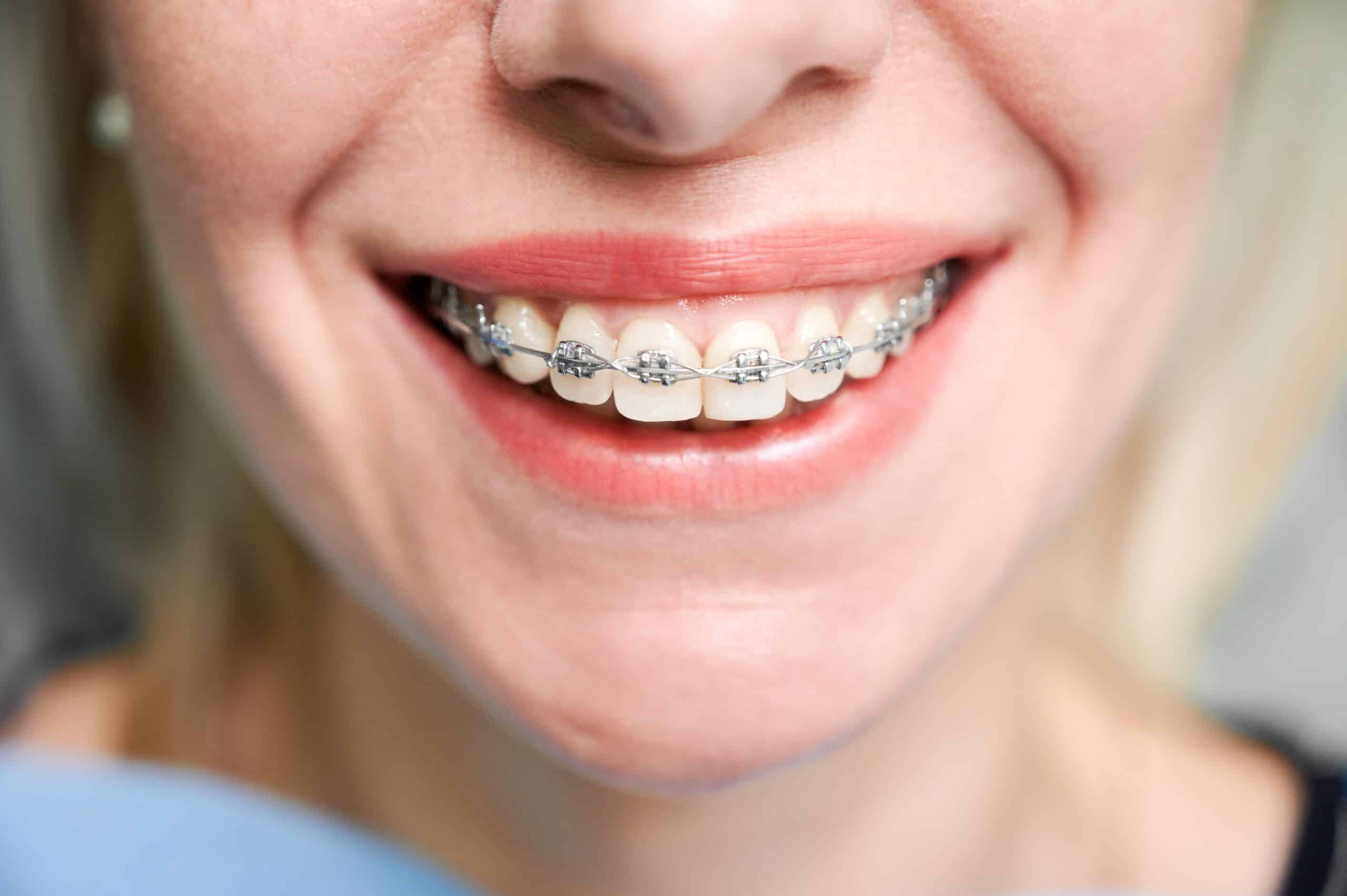 5 Myths That Are Widely Believed About Braces