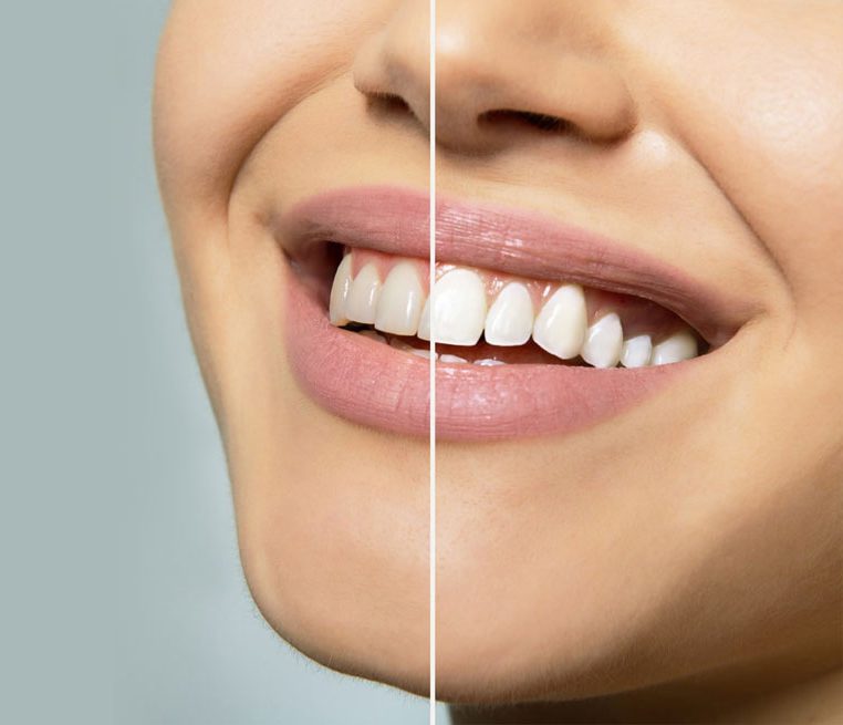 The Zoom Teeth Whitening Procedure Steps: