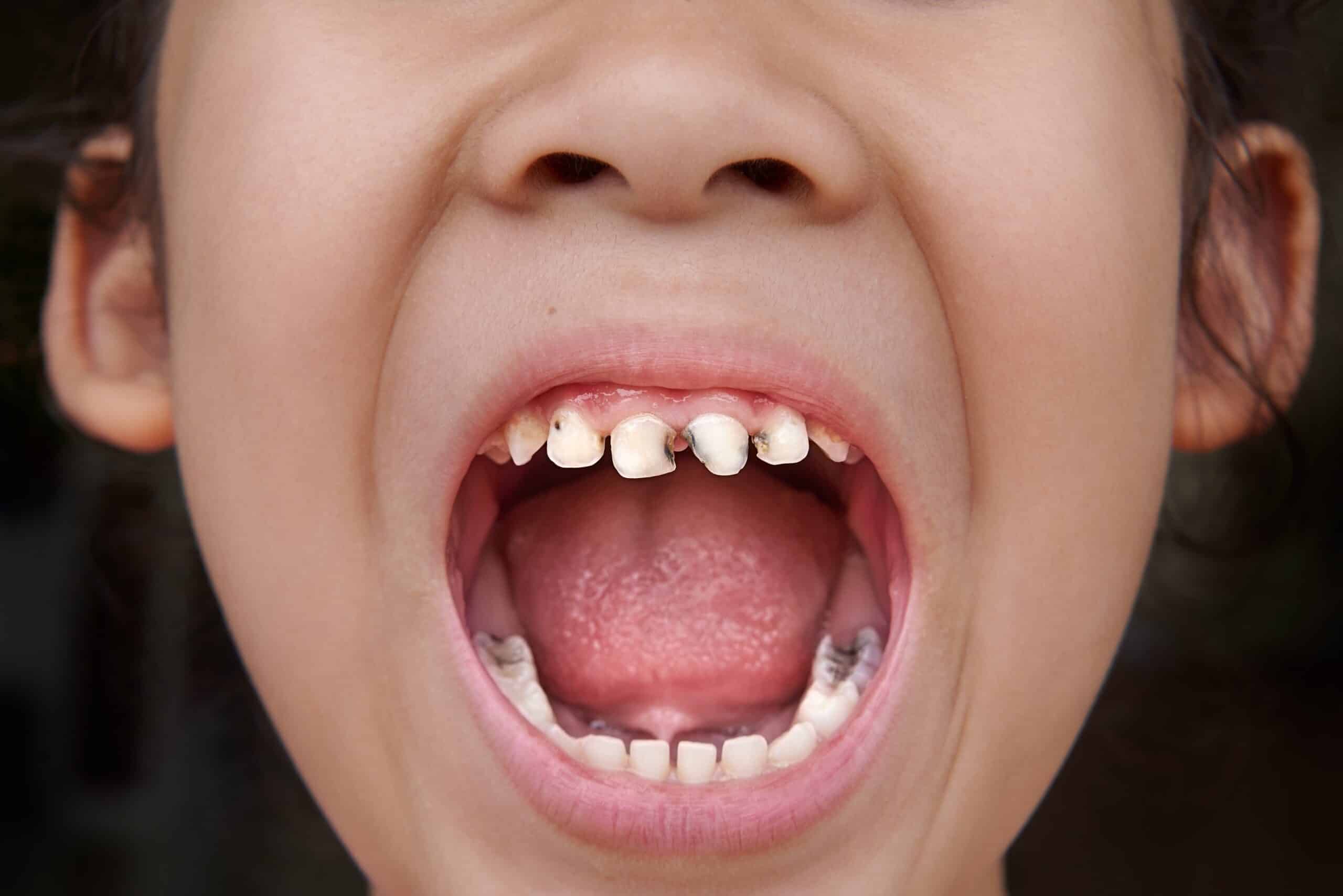 Can You Heal a Cavity Without Going to the Doctor