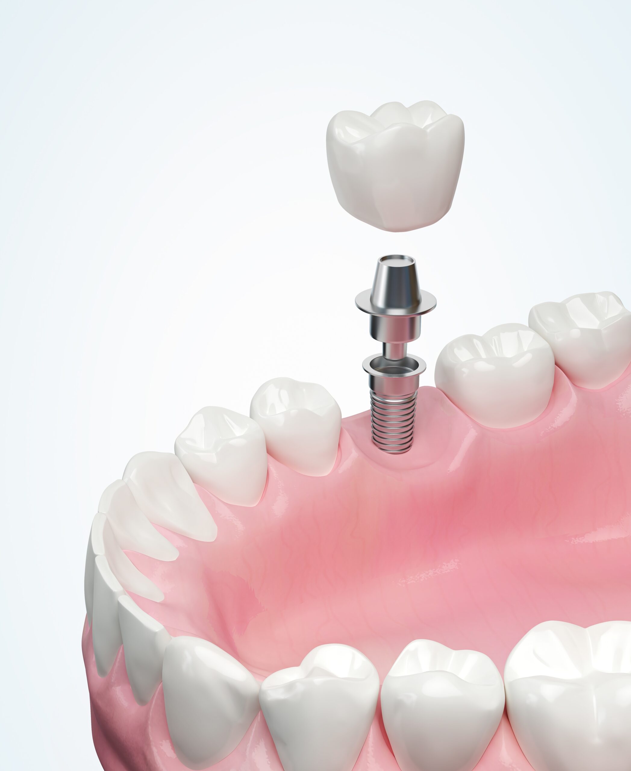 Restore Missing Teeth with BioHorizons Implants in Dubai