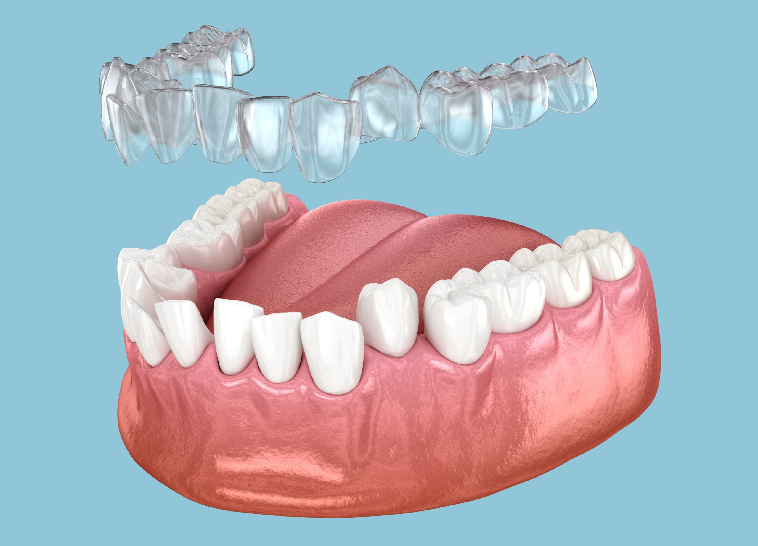 Straighten Your Teeth with Invisalign in Dubai: Benefits, Process & Why Choose Us